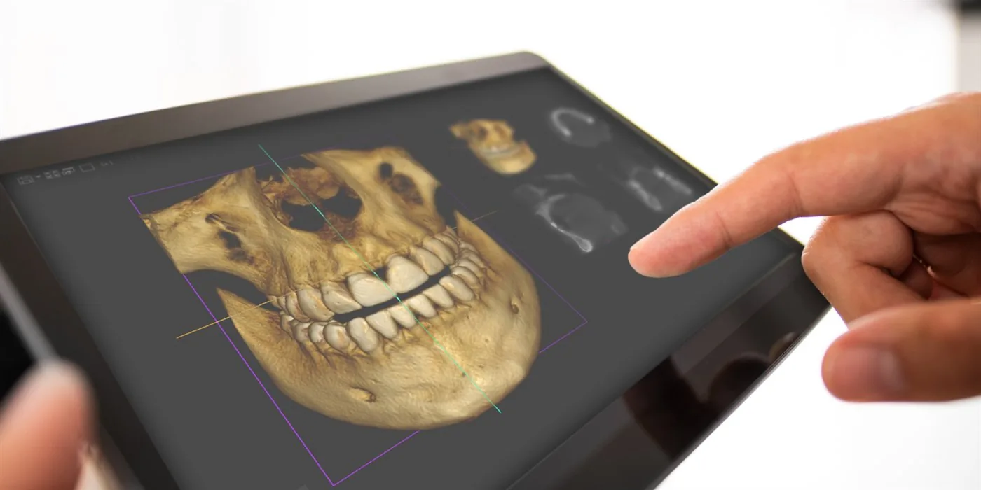 3D digitalno planiranje implanta na CBCT snimku