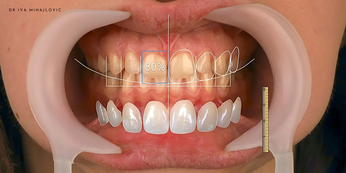 Digitalni Smile Design, prikaz budućeg osmeha sa merama